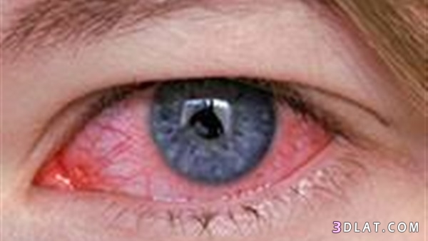 التهاب العين ، طرق علاج التهاب العين ، اسهل طرق للقضاء على التهاب العين 201