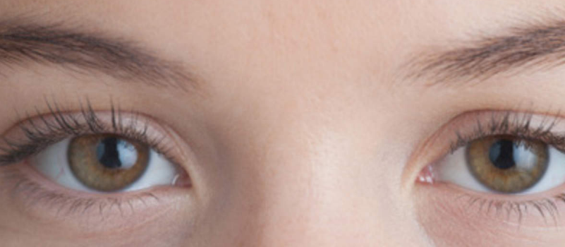 فيتامين e والهالات السوداء، أسباب ظهور الهالات السوداء حول العينين فوائد في