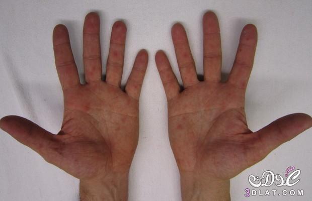 وصفات طبيعية لعلاج خشونة وجفاف اليدين - أسهل وصفات لحل جفاف وخشونة اليدين - خلطات لعلاج جفاف البشرة نهائيا