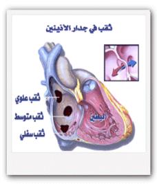 علاج ثقب القلب ,ملف كامل عن اسباب حدوث ثقب القلب عند الاطفال,ماهو القلب الازرق,العلاج