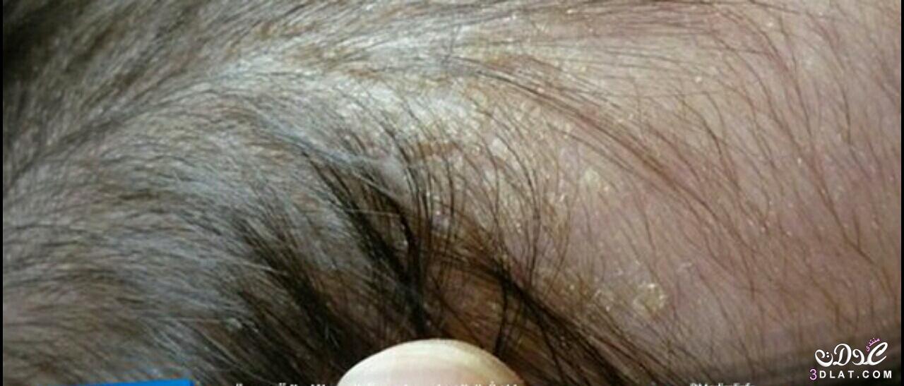 *قشور فروة الرأس في الأطفال حديثي الولادة.. أمر طبيعي  ظهور قشور فى شعر المولود