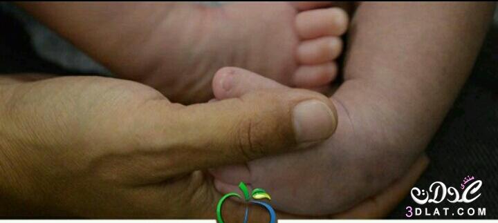 القدم المخلبية أو القدم الحنفاء عند الاطفال.ماهى القدم المخلبية و طرق التعامل معها