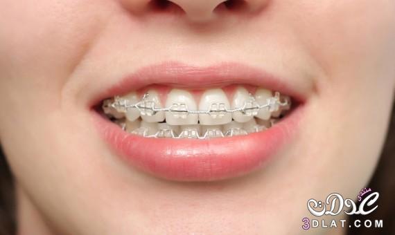 تقويم الاسنان ، معلومات مفيده عن تقويم الاسنان
