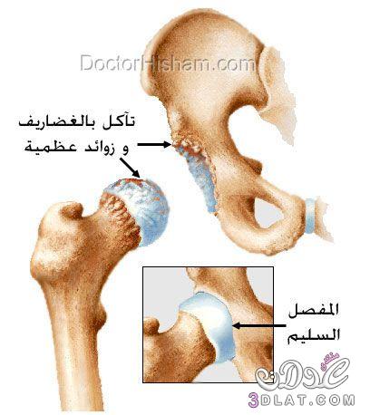 خشونة مفصل الفخذ والركبة والعلاج