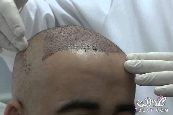 عمليات زرع الشعر من الالف الي الياء - ملف كامل عن زراعة الشعر - الاعراض الجانبية لعملية زراعة الشعر
