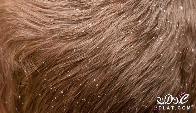 علاج قشر الشعر،وتقصفة وتساقطة ،نصائح فى كيفية العناية بالشعرتعرفي على كيفية علاج تقش
