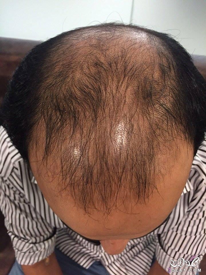 تجربة زوجي في مركز غولد هير سنتر لزراعة الشعر