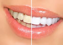 تبييض الاسنان احصلي على ابتسامة ناصعة البياض خلال دقيقة واحدة بهذه الوصفات