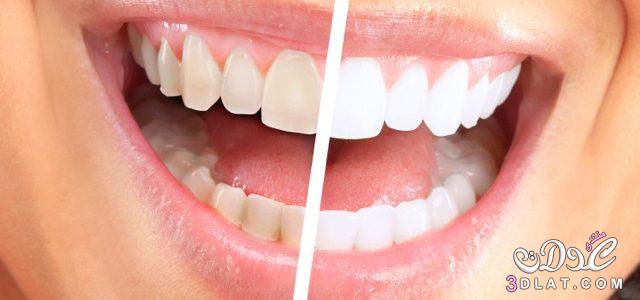 وصفات طبيعية من المنزل لتبيض الأسنان, كيف تجعلي اسنانك بيضاء دون الذهاب لطبيب