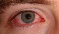 احمرار العين اسباب احمرار العين علاج احمرار العين