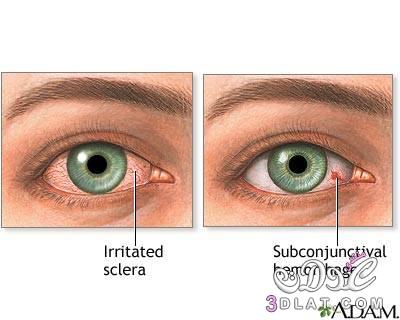 احمرار العين Eye Redness , نصائح للتخلص من احمرار العين