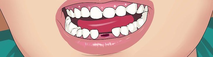 خلع الاسنان في المنزل,اسهل طريقة خلع الأسنان بالمنزل بدون ألم,لازالة الاسنان اللبنيه