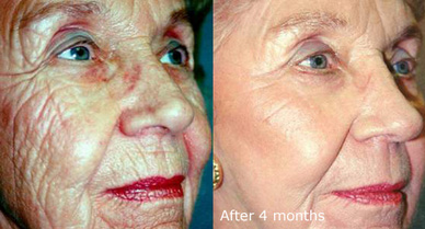 العيادة الطبية /تجميل الوجه خلال ساعة  الفرق بين الشيخوخة والشيخوخة الجميلة يمكن أن ي