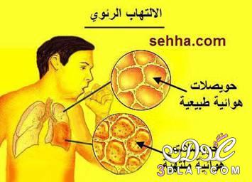 حشيشة القنفذ تنشط مناعة الجسم وتشفي من الالتهاب الرئوي !