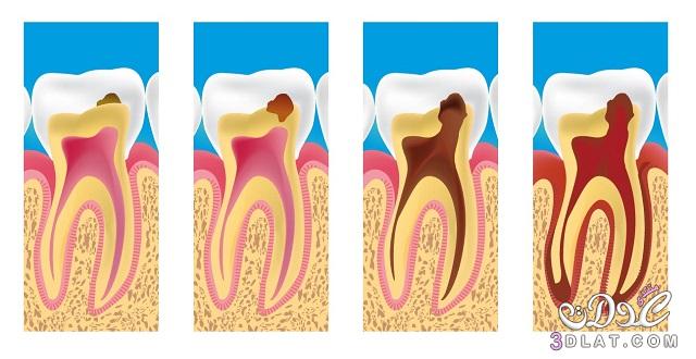 علاج تسوس الاسنان, الوقاية من تسوس الاسنان