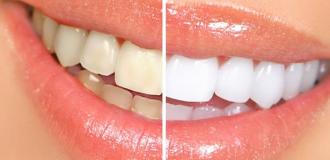 تبييض الاسنان طريقه لبياض الاسنان وصفه \طبيعيه لتبييض الاسنان