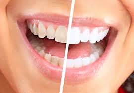 تبيض الاسنان في المنزل , 5 خلطات طبيعية للحصول على أسنان بيضاء كالثلج 2024