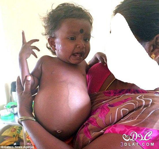 ولادة "جنين فى بطن جنين" لطفلة بالهند
