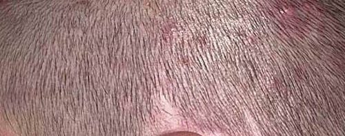 التهاب جريبات الشعر