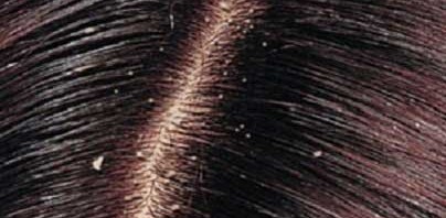 اسبراي فيزي كلير للقضاء على قشرة الشعر ,فوائد استخدام سبراي فيزي كلير,الاثار الجانبيه لاسبراي فيزي كلير
