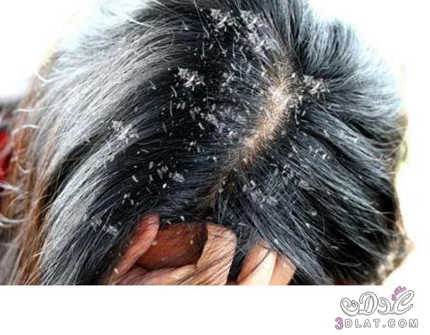 وصفة للتخلص من القشرة نهائياً, قشرة الشعر, تخلصي من قشرة الرأس في الشتاء