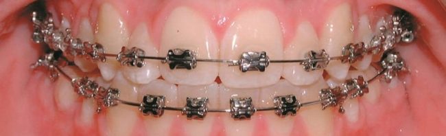اعوجاج الأسنان وكيفية علاجه,المشكلات المترتبة على اعوجاج الأسنان,فوائد علاج اعوجاج ال
