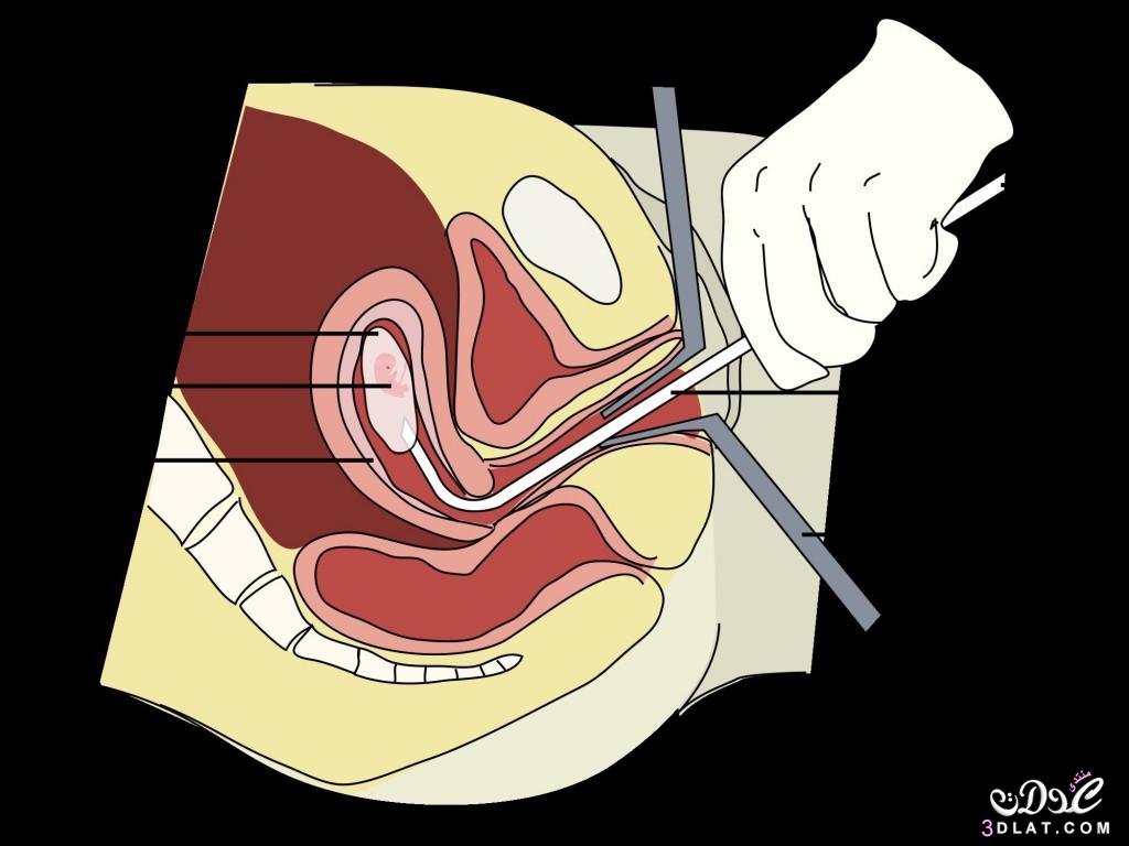 بعد الاجهاض يجب الحذر ,اعراض خطيره بعد الاجهاض يجب الحذر منها