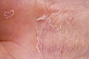 التهاب الجلد التقشري,ما هي مخاطر التهاب الجلد التقشري